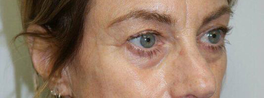 Upper Blepharoplasty Before & After Image