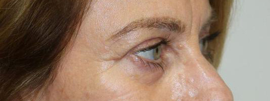 Upper Blepharoplasty Before & After Image