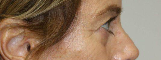 Upper Blepharoplasty Before & After Image