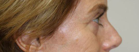 Upper Blepharoplasty Before & After Image