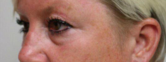 Upper Blepharoplasty Before & After Image