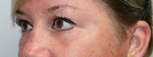 Upper Blepharoplasty Before & After Image