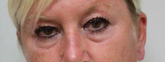 Upper Blepharoplasty Before & After Image