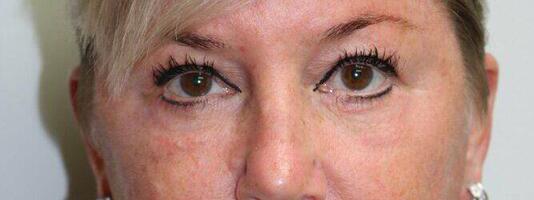 Upper Blepharoplasty Before & After Image