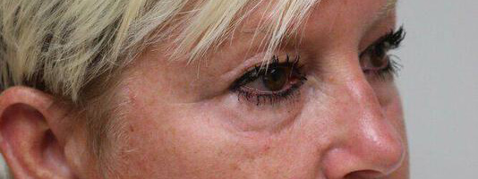 Upper Blepharoplasty Before & After Image