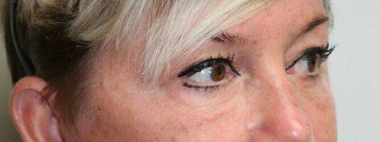 Upper Blepharoplasty Before & After Image