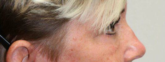 Upper Blepharoplasty Before & After Image