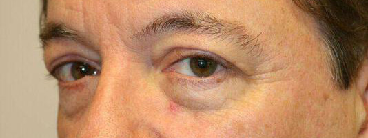 Upper Blepharoplasty Before & After Image