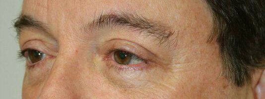 Upper Blepharoplasty Before & After Image