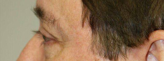 Upper Blepharoplasty Before & After Image