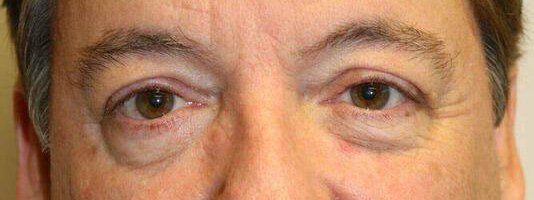 Upper Blepharoplasty Before & After Image