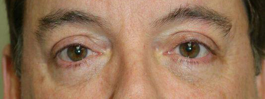 Upper Blepharoplasty Before & After Image