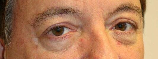 Upper Blepharoplasty Before & After Image