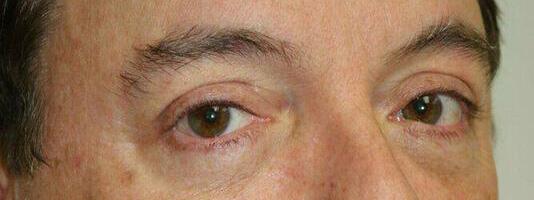 Upper Blepharoplasty Before & After Image