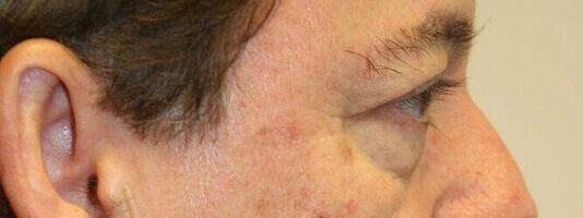 Upper Blepharoplasty Before & After Image