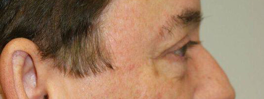 Upper Blepharoplasty Before & After Image