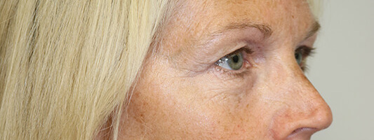 Upper Blepharoplasty Before & After Image