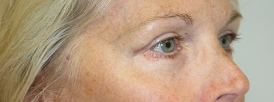 Upper Blepharoplasty Before & After Image