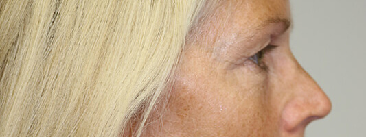 Upper Blepharoplasty Before & After Image