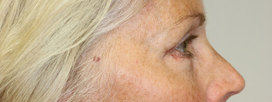 Upper Blepharoplasty Before & After Image