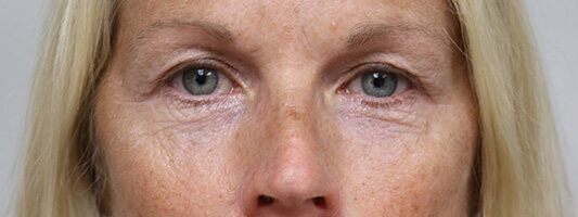 Upper Blepharoplasty Before & After Image