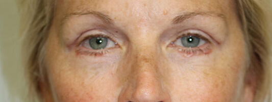 Upper Blepharoplasty Before & After Image