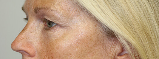 Upper Blepharoplasty Before & After Image