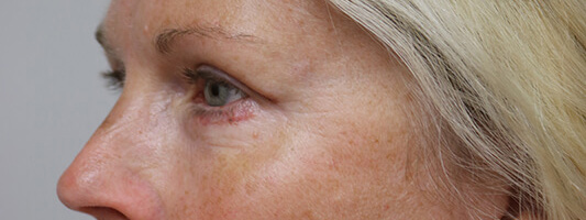 Upper Blepharoplasty Before & After Image