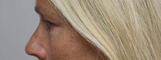 Upper Blepharoplasty Before & After Image