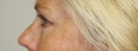 Upper Blepharoplasty Before & After Image