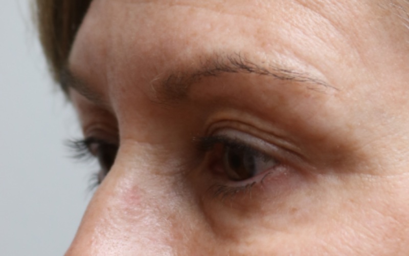 Upper Blepharoplasty Before & After Image