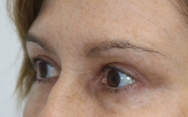 Upper Blepharoplasty Before & After Image