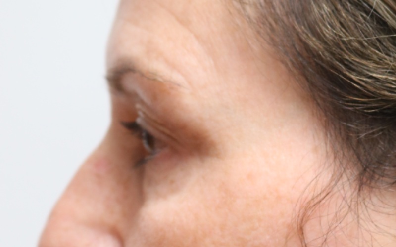 Upper Blepharoplasty Before & After Image