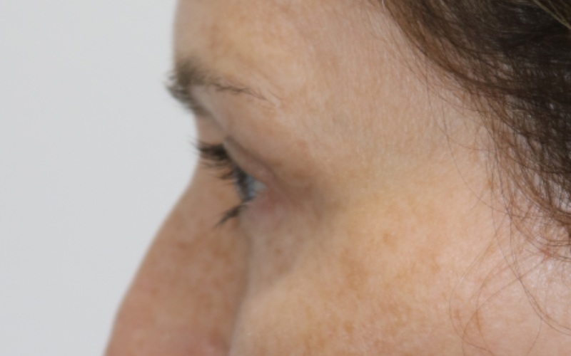 Upper Blepharoplasty Before & After Image