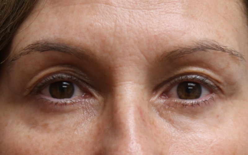 Upper Blepharoplasty Before & After Image