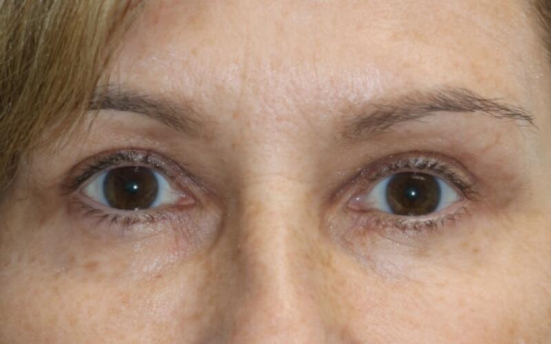 Upper Blepharoplasty Before & After Image