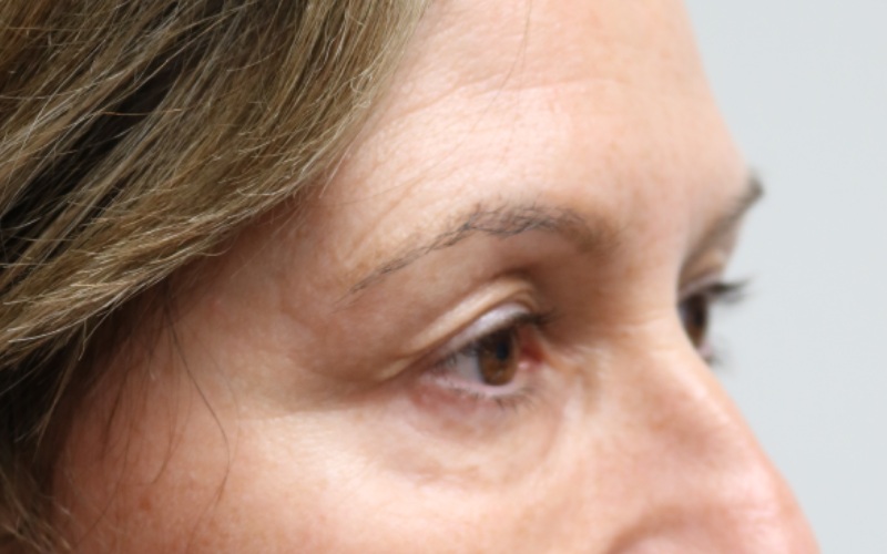 Upper Blepharoplasty Before & After Image