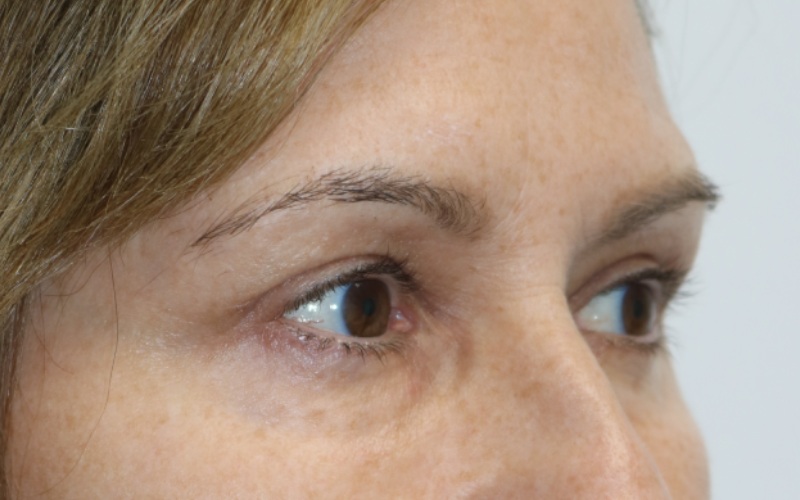 Upper Blepharoplasty Before & After Image