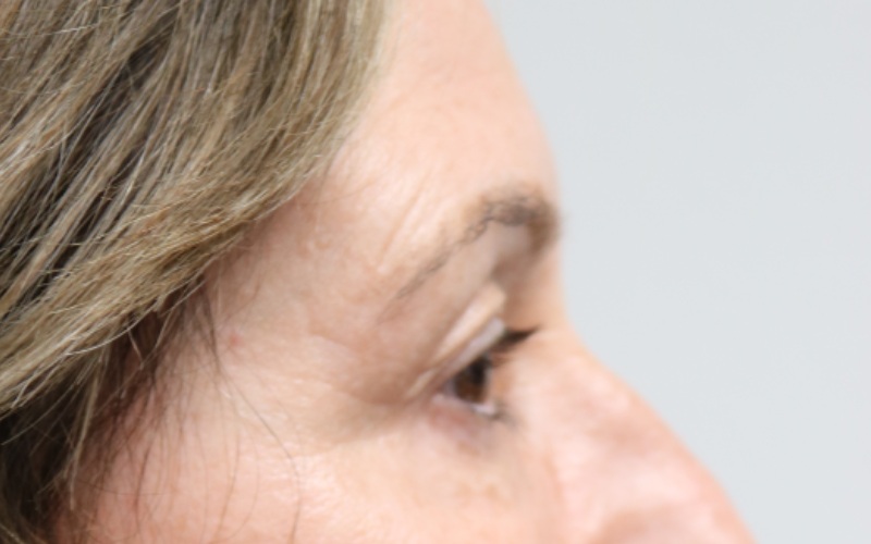 Upper Blepharoplasty Before & After Image