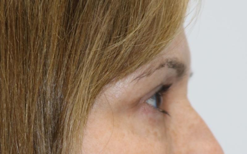 Upper Blepharoplasty Before & After Image