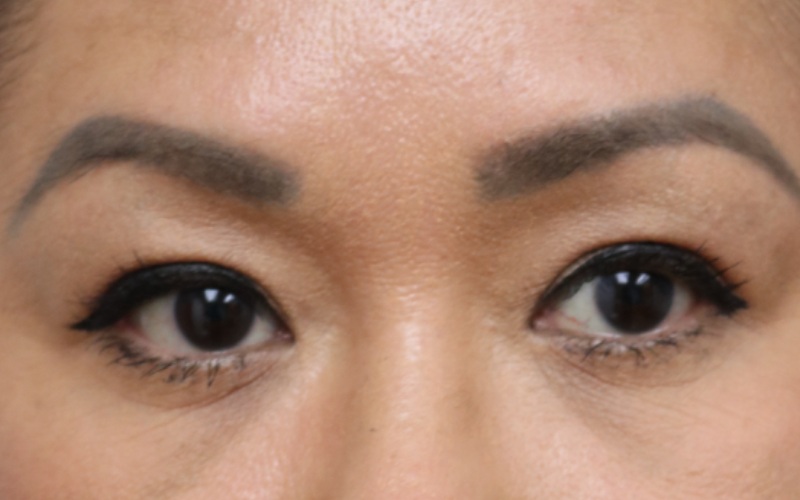 Upper Blepharoplasty Before & After Image