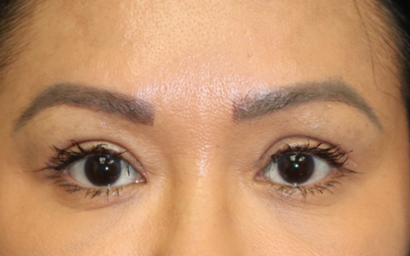 Upper Blepharoplasty Before & After Image