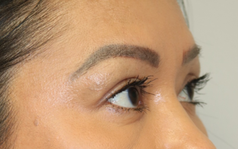 Upper Blepharoplasty Before & After Image