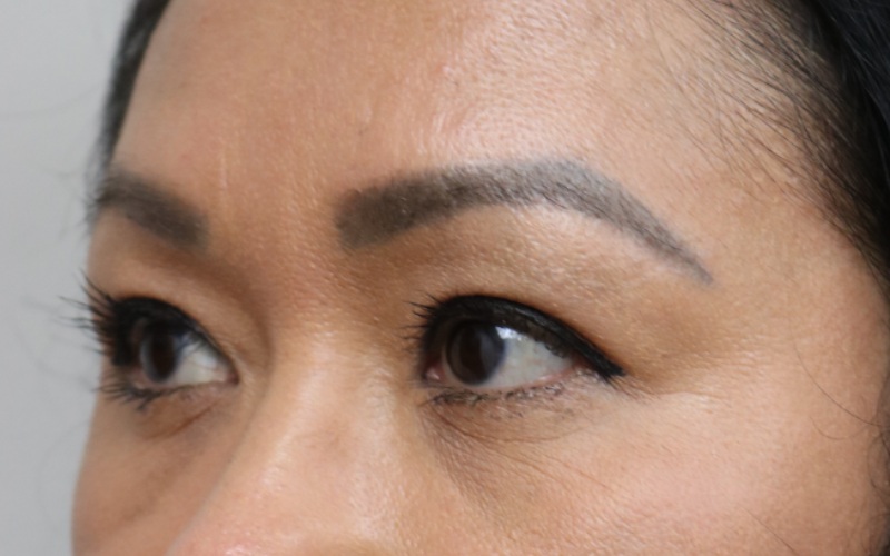 Upper Blepharoplasty Before & After Image