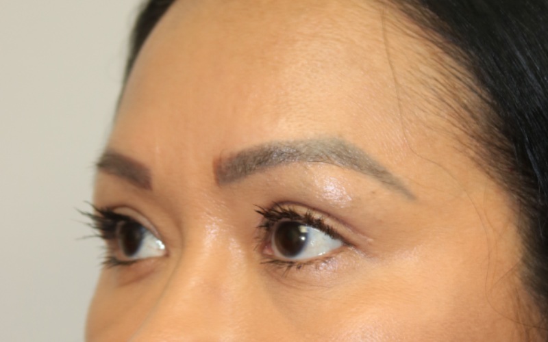 Upper Blepharoplasty Before & After Image