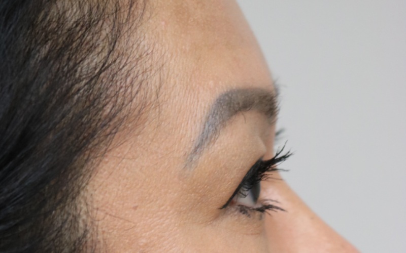 Upper Blepharoplasty Before & After Image