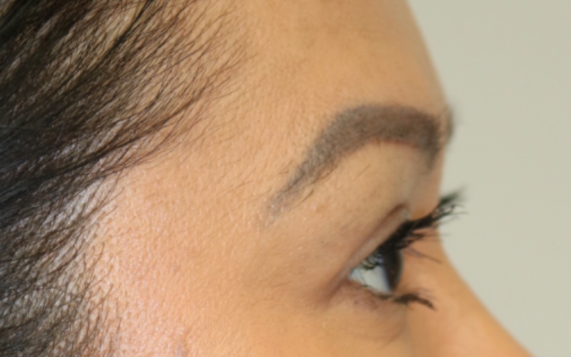 Upper Blepharoplasty Before & After Image