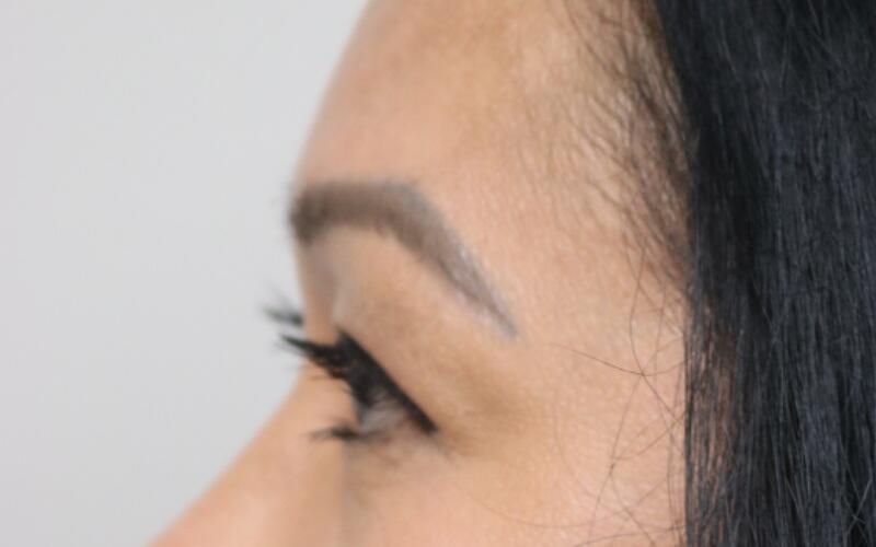 Upper Blepharoplasty Before & After Image