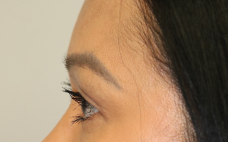 Upper Blepharoplasty Before & After Image