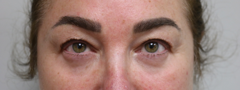 Upper Blepharoplasty Before & After